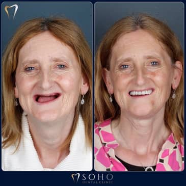 Slider image (4) Soho Dental Clinic